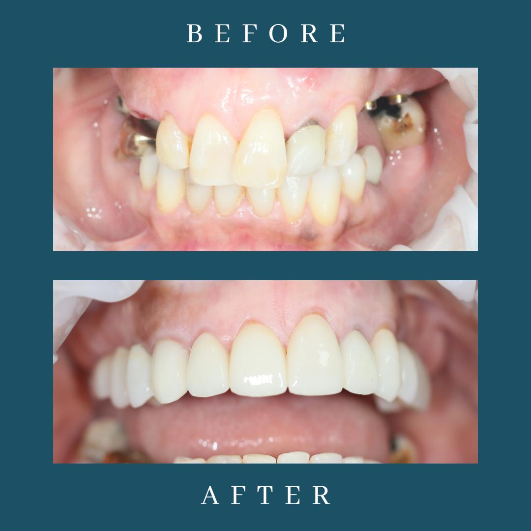 patient before and after implant treatment in dentist leicester