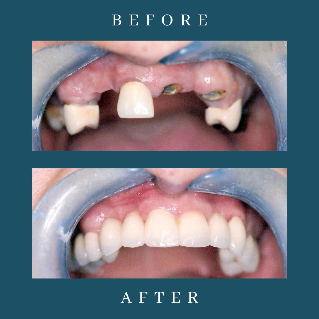 dental implant before and after at dentist in leicester
