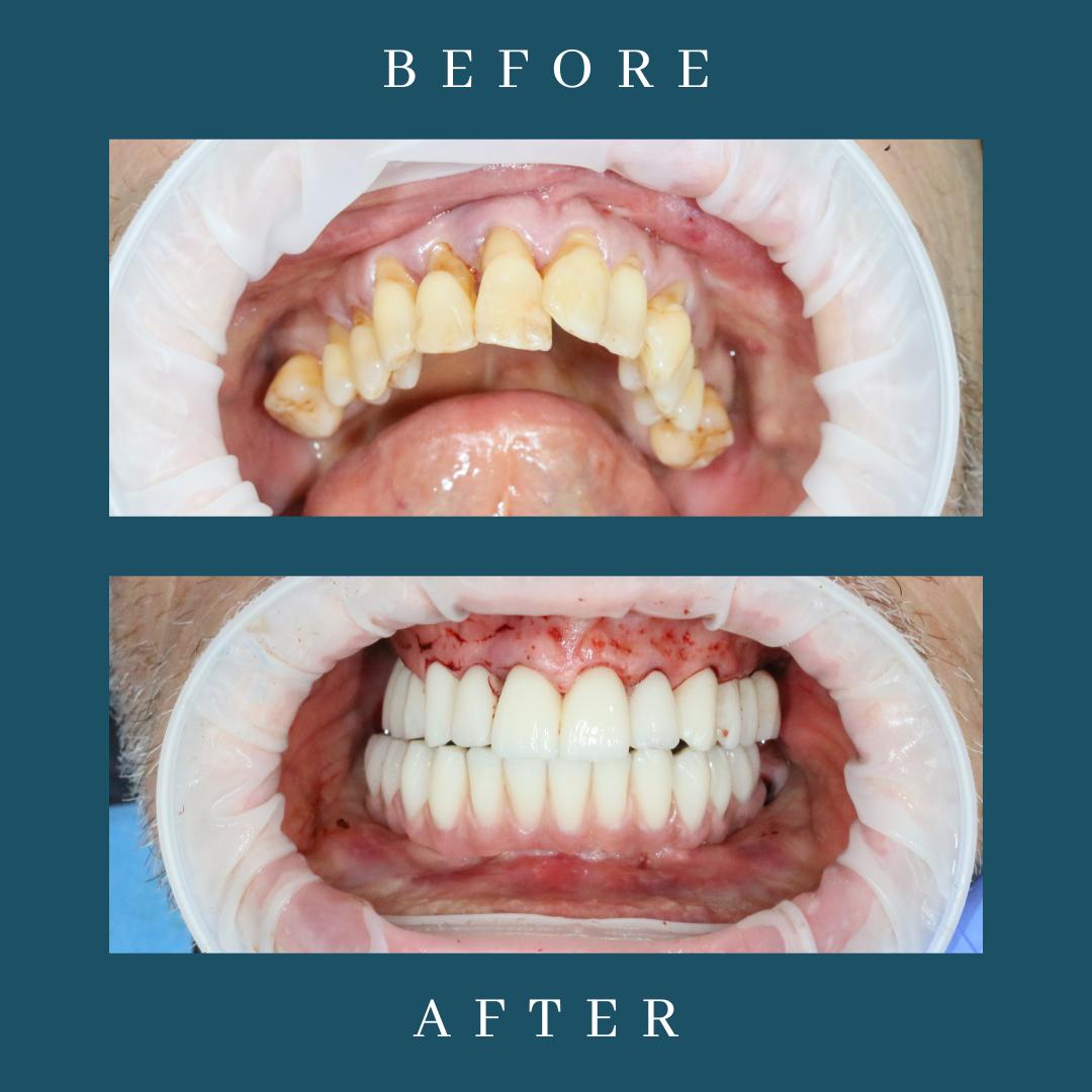 dental implant before and after at dentist in leicester